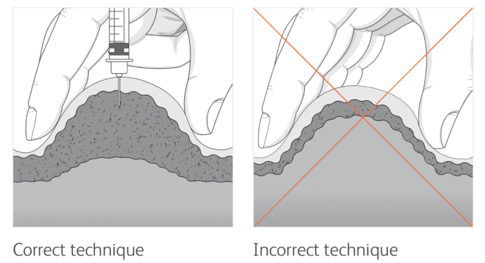 Pinch the skin to separate the adipose tissue from muscle when administering an subcutaneous injection with a longer needle.