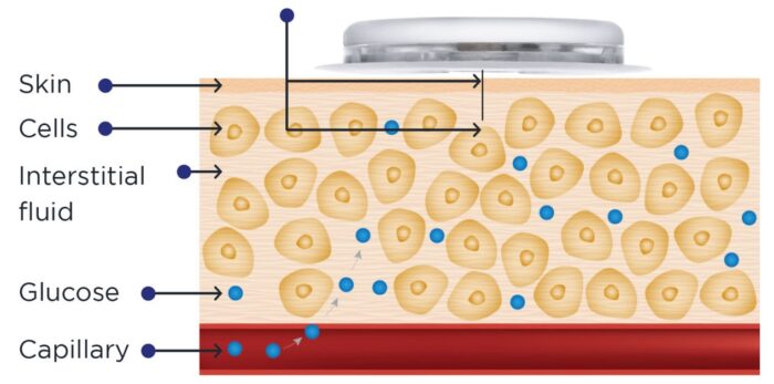 Your Guide to Diabetes Supplies Continuous Glucose monitoring - how does it work? Sarah Hormachea